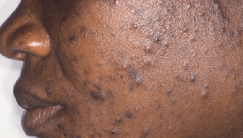 Maya Acne image